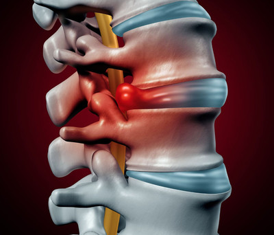 Diagram comparing normal disc, bulging disc, and herniated disc – treated at Core Chiropractic Waukee, Iowa